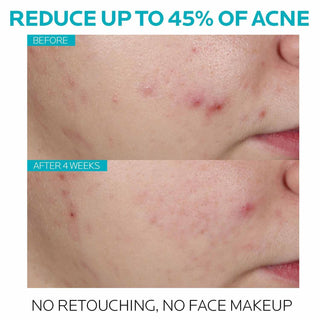 La Roche Posay Effacler Salicylic Acid Acne Treatment Serum (Green) - 30ml